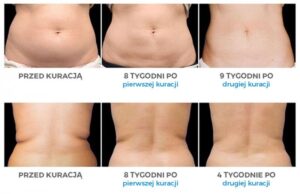 Kriolipoliza – jak odchudzanie zimnem zmienia nasze ciało?