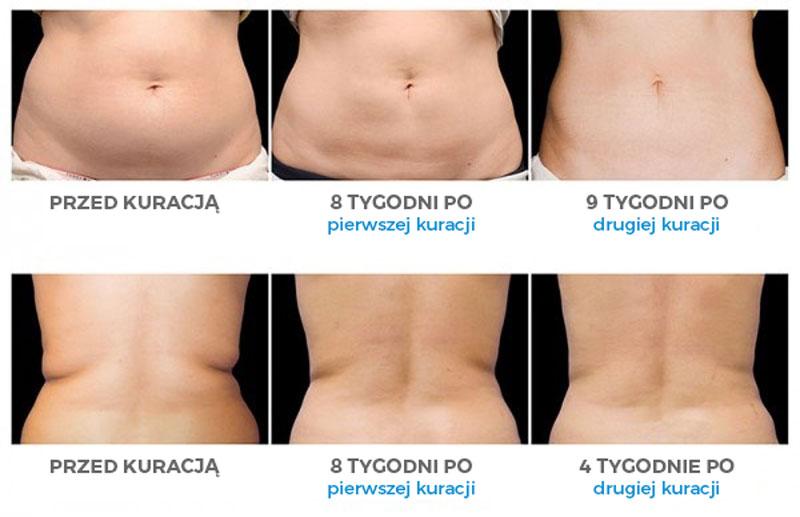 Kriolipoliza – jak odchudzanie zimnem zmienia nasze ciało?