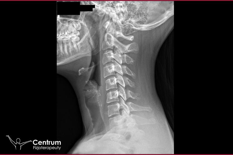 Drętwienie rąk choroby neurologiczne