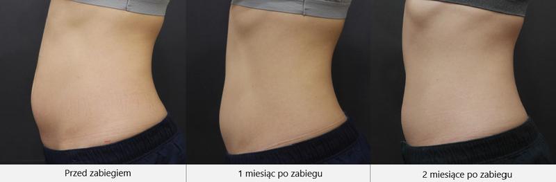 Redukcja brzucha bez utraty biustu