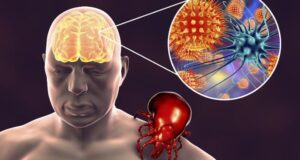 Jak chronić się przed kleszczowym zapaleniem mózgu: objawy, profilaktyka i leczenie