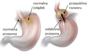 Jak przepuklina przełyku wpływa na trening siłowy? Oto, co musisz wiedzieć