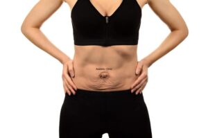 Jak radzić sobie z obwisłą skórą po odchudzaniu? Poradnik dla każdego